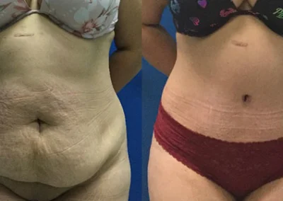 abdominoplasty tummy tuck before and after photo by reichner plastic surgery in orange ca