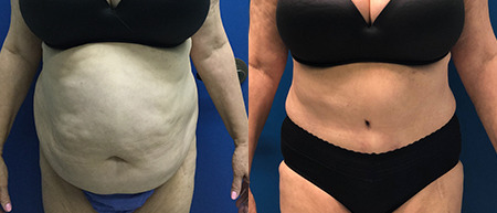 abdominoplasty tummy tuck before and after photo by reichner plastic surgery in orange ca