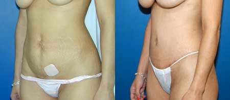 abdominoplasty tummy tuck before and after photo by reichner plastic surgery in orange ca