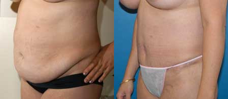 abdominoplasty tummy tuck before and after photo by reichner plastic surgery in orange ca
