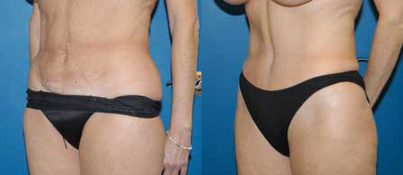 abdominoplasty tummy tuck before and after photo by reichner plastic surgery in orange ca