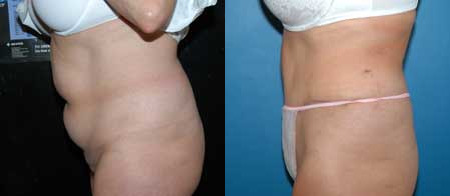 abdominoplasty tummy tuck before and after photo by reichner plastic surgery in orange ca