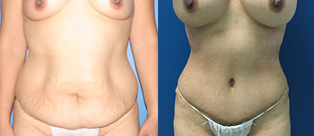 abdominoplasty tummy tuck before and after photo by reichner plastic surgery in orange ca