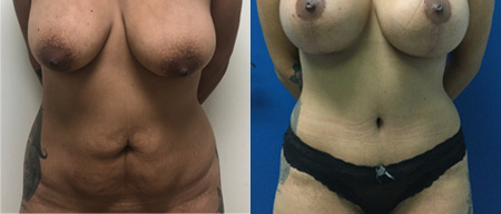 abdominoplasty tummy tuck before and after photo by reichner plastic surgery in orange ca