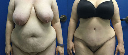 abdominoplasty tummy tuck before and after photo by reichner plastic surgery in orange ca