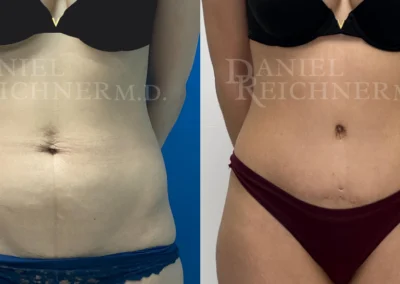 abdominoplasty tummy tuck before and after photo by reichner plastic surgery in orange ca