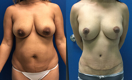 abdominoplasty tummy tuck before and after photo by reichner plastic surgery in orange ca