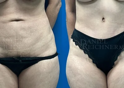 abdominoplasty tummy tuck before and after photo by reichner plastic surgery in orange ca