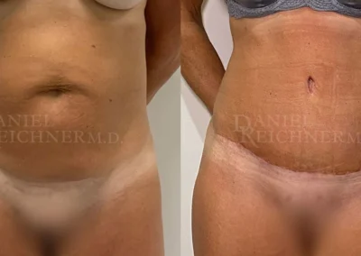 abdominoplasty tummy tuck before and after photo by reichner plastic surgery in orange ca