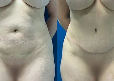 abdominoplasty tummy tuck before and after photo by reichner plastic surgery in orange ca