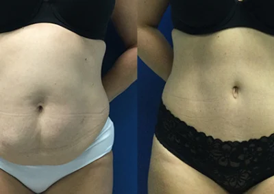 abdominoplasty tummy tuck before and after photo by reichner plastic surgery in orange ca