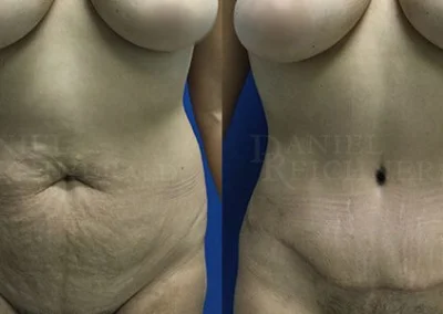 abdominoplasty tummy tuck before and after photo by reichner plastic surgery in orange ca