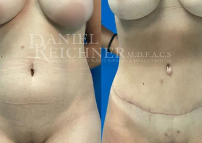 abdominoplasty tummy tuck before and after photo by reichner plastic surgery in orange ca
