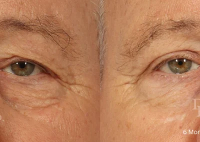 eyelid surgery before and after photo by reichner plastic surgery in orange ca