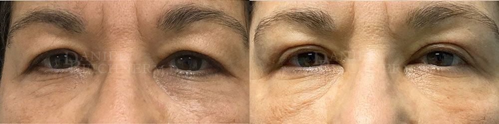 eyelid surgery before and after photo by reichner plastic surgery in orange ca