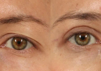 eyelid surgery before and after photo by reichner plastic surgery in orange ca