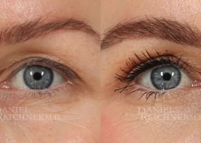 eyelid surgery before and after photo by reichner plastic surgery in orange ca