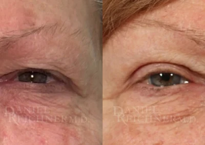 eyelid surgery before and after photo by reichner plastic surgery in orange ca