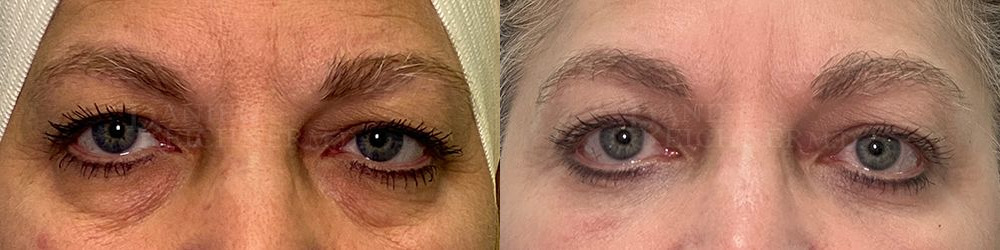 eyelid surgery before and after photo by reichner plastic surgery in orange ca
