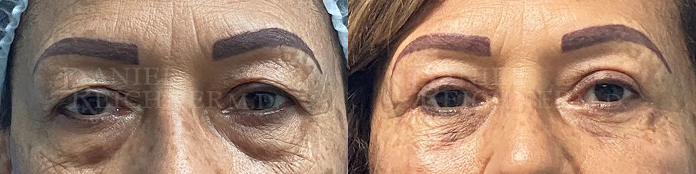 eyelid surgery before and after photo by reichner plastic surgery in orange ca