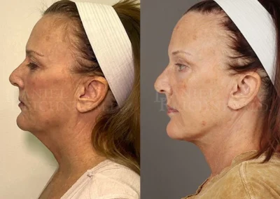 facelift necklift before and after photo by reichner plastic surgery in orange ca