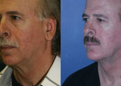 facelift necklift before and after photo by reichner plastic surgery in orange ca