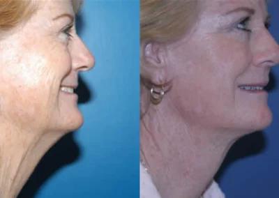 facelift necklift before and after photo by reichner plastic surgery in orange ca