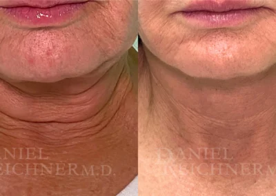 facelift necklift before and after photo by reichner plastic surgery in orange ca
