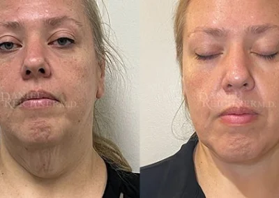 facelift necklift before and after photo by reichner plastic surgery in orange ca