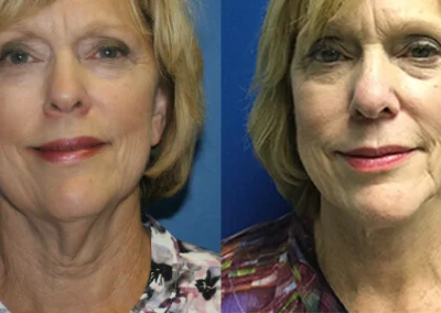 facelift necklift before and after photo by reichner plastic surgery in orange ca