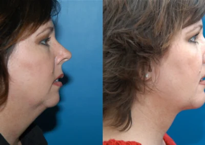 facelift necklift before and after photo by reichner plastic surgery in orange ca