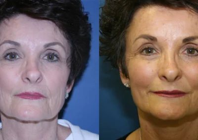 facelift necklift before and after photo by reichner plastic surgery in orange ca