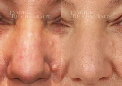 rhinoplasty before and after photo by reichner plastic surgery in orange ca