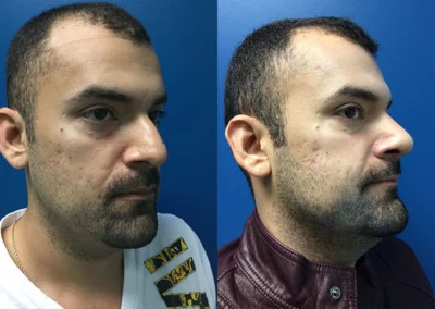rhinoplasty before and after photo by reichner plastic surgery in orange ca
