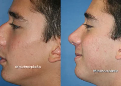rhinoplasty before and after photo by reichner plastic surgery in orange ca