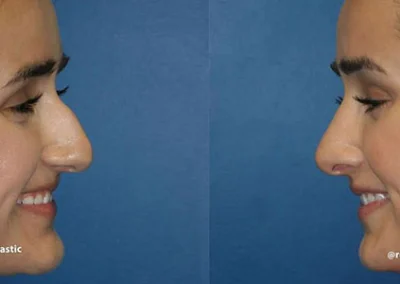 rhinoplasty before and after photo by reichner plastic surgery in orange ca