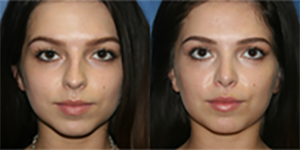 rhinoplasty before and after photo by reichner plastic surgery in orange ca
