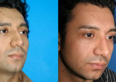 rhinoplasty before and after photo by reichner plastic surgery in orange ca