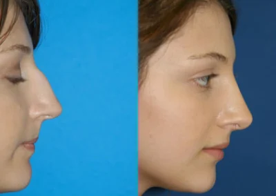 rhinoplasty before and after photo by reichner plastic surgery in orange ca