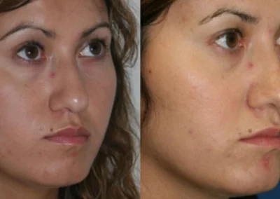 rhinoplasty before and after photo by reichner plastic surgery in orange ca