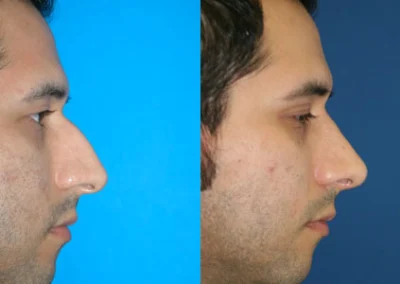rhinoplasty before and after photo by reichner plastic surgery in orange ca