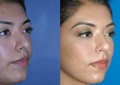 rhinoplasty before and after photo by reichner plastic surgery in orange ca