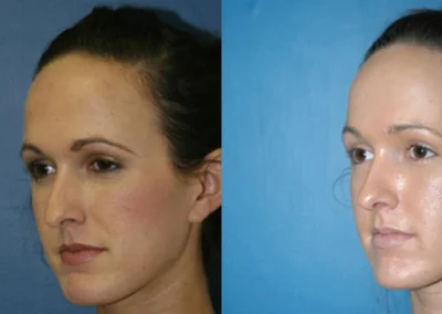 rhinoplasty before and after photo by reichner plastic surgery in orange ca