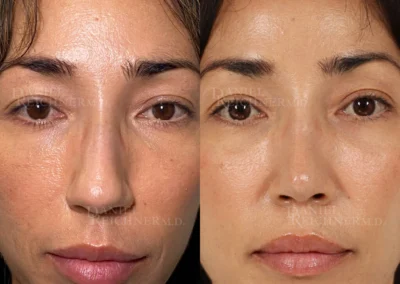 rhinoplasty before and after photo by reichner plastic surgery in orange ca