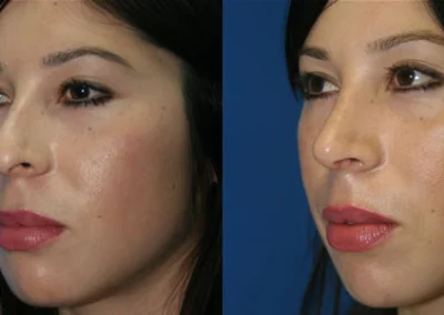 rhinoplasty before and after photo by reichner plastic surgery in orange ca