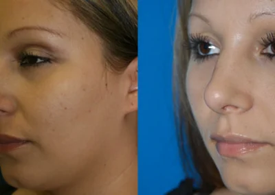 rhinoplasty before and after photo by reichner plastic surgery in orange ca
