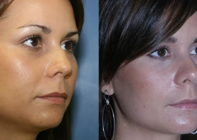 rhinoplasty before and after photo by reichner plastic surgery in orange ca
