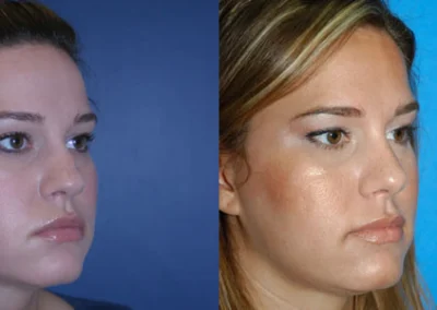 rhinoplasty before and after photo by reichner plastic surgery in orange ca
