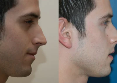 rhinoplasty before and after photo by reichner plastic surgery in orange ca