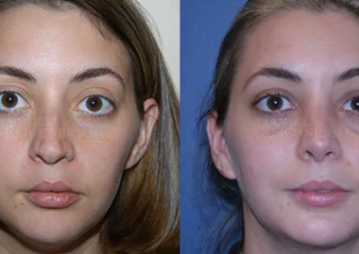 rhinoplasty before and after photo by reichner plastic surgery in orange ca